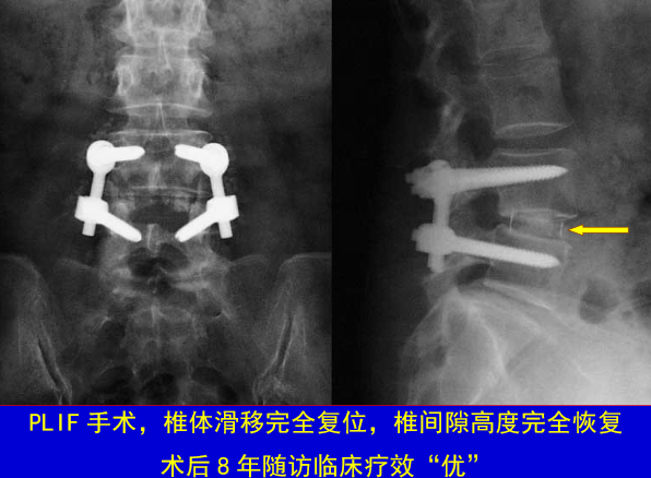 怎样判定腰椎管狭窄症的手术责任椎？