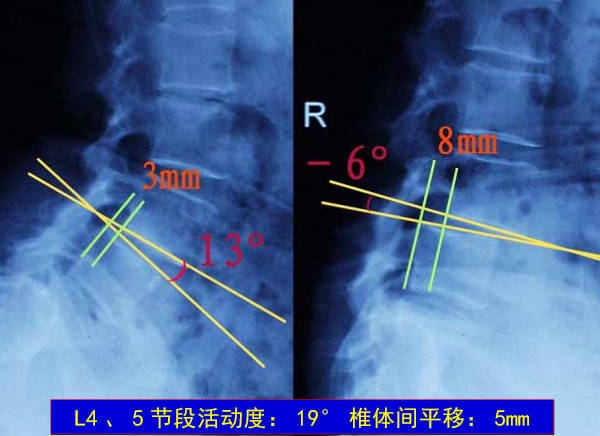 怎样判定腰椎管狭窄症的手术责任椎？