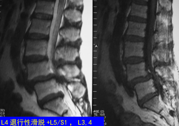 怎样判定腰椎管狭窄症的手术责任椎？