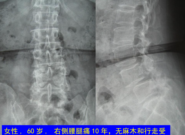 怎样判定腰椎管狭窄症的手术责任椎？