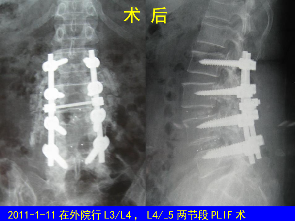 怎样判定腰椎管狭窄症的手术责任椎？