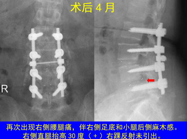 怎样判定腰椎管狭窄症的手术责任椎？