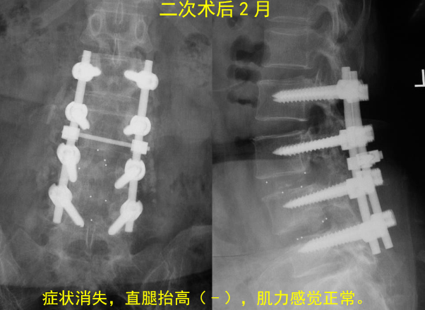 怎样判定腰椎管狭窄症的手术责任椎？