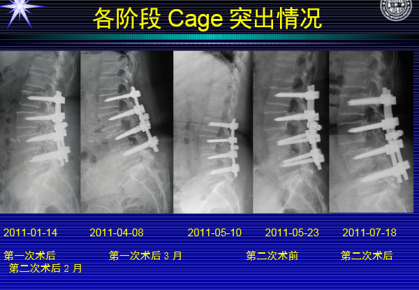 怎样判定腰椎管狭窄症的手术责任椎？