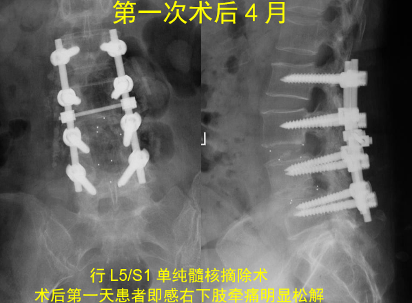 怎样判定腰椎管狭窄症的手术责任椎？