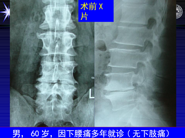 怎样判定腰椎管狭窄症的手术责任椎？