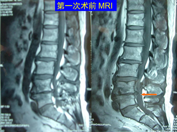 怎样判定腰椎管狭窄症的手术责任椎？