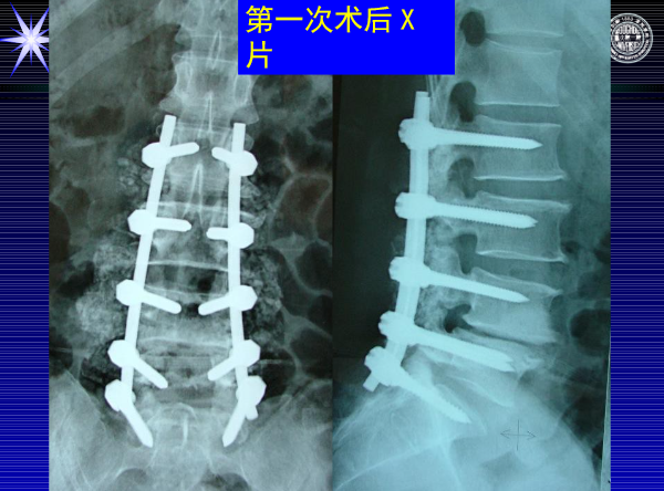 怎样判定腰椎管狭窄症的手术责任椎？