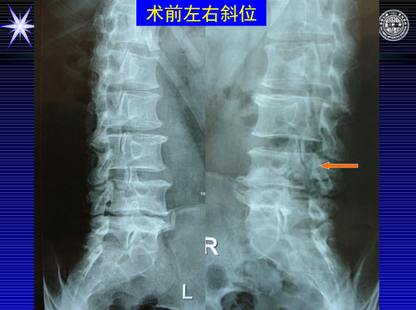 怎样判定腰椎管狭窄症的手术责任椎？