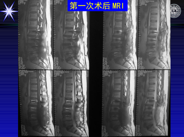 怎样判定腰椎管狭窄症的手术责任椎？