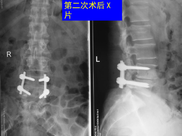 怎样判定腰椎管狭窄症的手术责任椎？