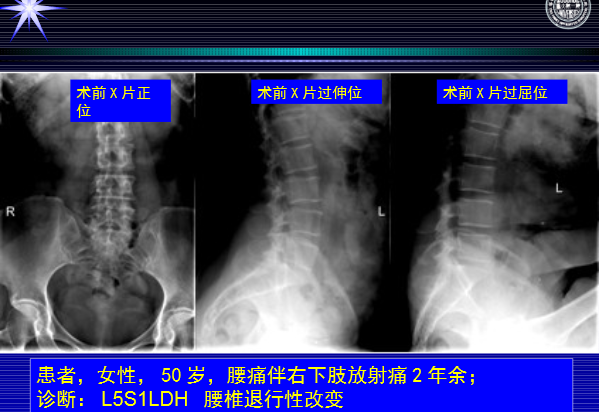 怎样判定腰椎管狭窄症的手术责任椎？