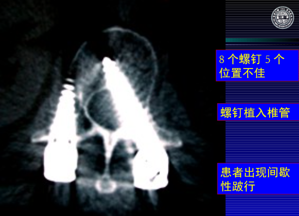 怎样判定腰椎管狭窄症的手术责任椎？