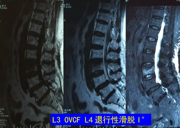 怎样判定腰椎管狭窄症的手术责任椎？