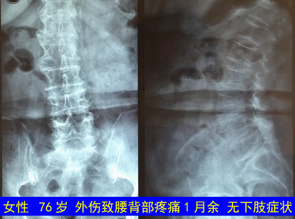 怎样判定腰椎管狭窄症的手术责任椎？