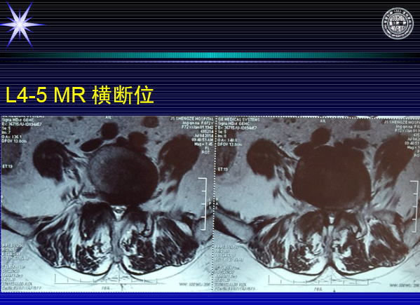 怎样判定腰椎管狭窄症的手术责任椎？