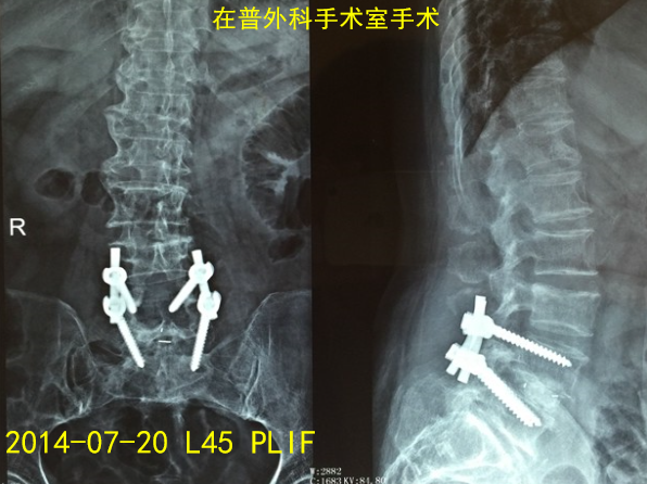 怎样判定腰椎管狭窄症的手术责任椎？