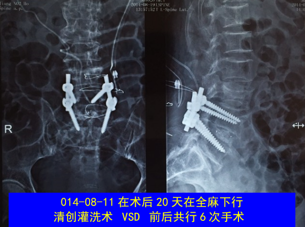 怎样判定腰椎管狭窄症的手术责任椎？