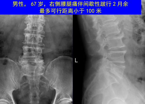 怎样判定腰椎管狭窄症的手术责任椎？