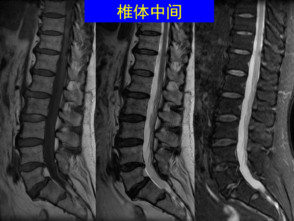 怎样判定腰椎管狭窄症的手术责任椎？