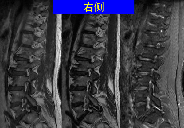 怎样判定腰椎管狭窄症的手术责任椎？