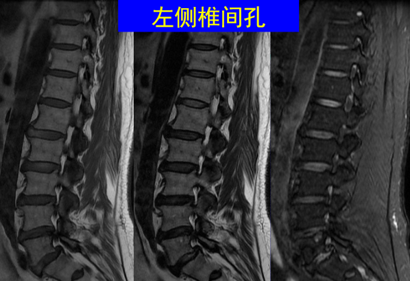 怎样判定腰椎管狭窄症的手术责任椎？