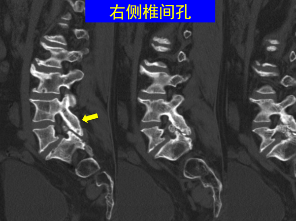 怎样判定腰椎管狭窄症的手术责任椎？