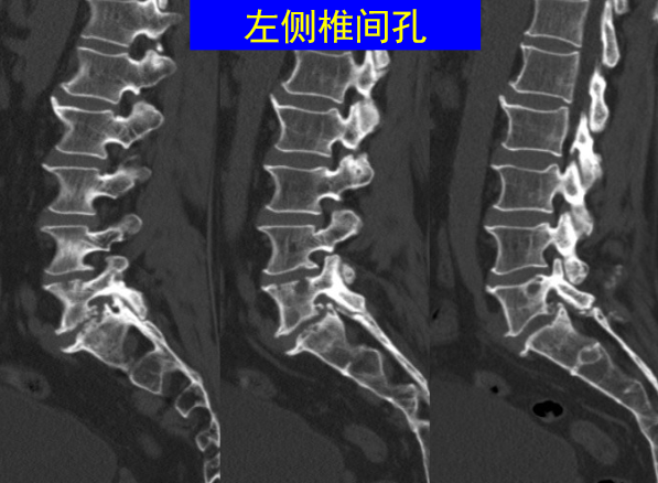 怎样判定腰椎管狭窄症的手术责任椎？