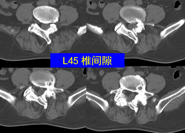 怎样判定腰椎管狭窄症的手术责任椎？