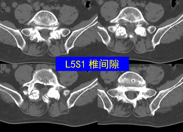 怎样判定腰椎管狭窄症的手术责任椎？