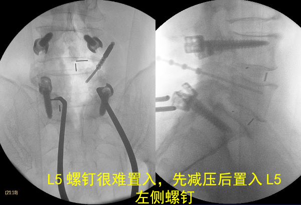 怎样判定腰椎管狭窄症的手术责任椎？