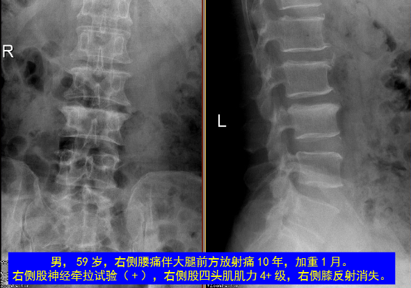 怎样判定腰椎管狭窄症的手术责任椎？