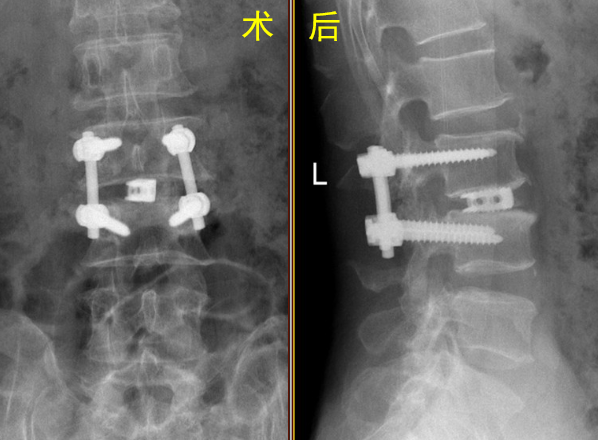 怎样判定腰椎管狭窄症的手术责任椎？