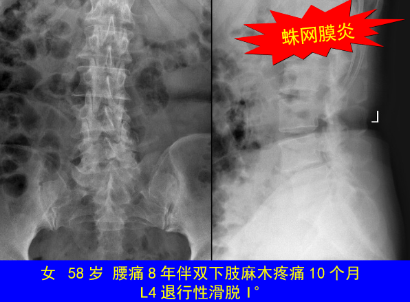 怎样判定腰椎管狭窄症的手术责任椎？