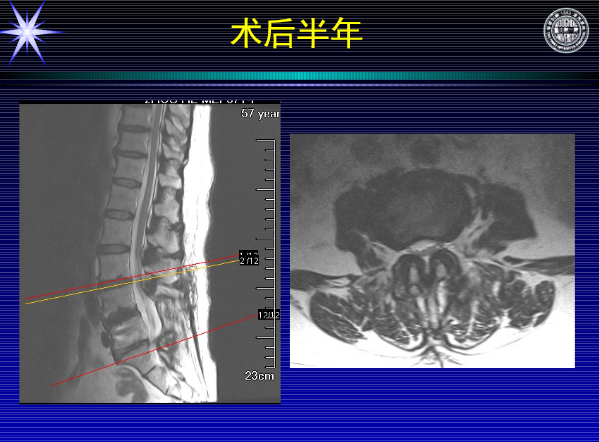 怎样判定腰椎管狭窄症的手术责任椎？