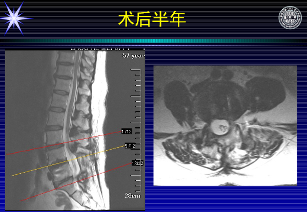 怎样判定腰椎管狭窄症的手术责任椎？