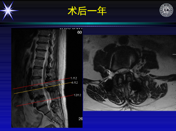 怎样判定腰椎管狭窄症的手术责任椎？