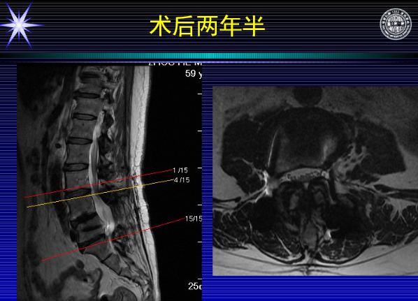 怎样判定腰椎管狭窄症的手术责任椎？