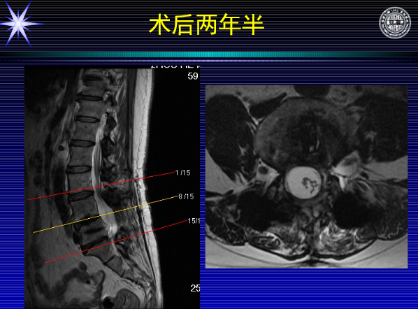 怎样判定腰椎管狭窄症的手术责任椎？