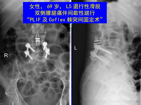 怎样判定腰椎管狭窄症的手术责任椎？