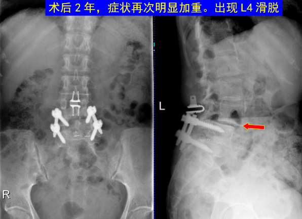 怎样判定腰椎管狭窄症的手术责任椎？