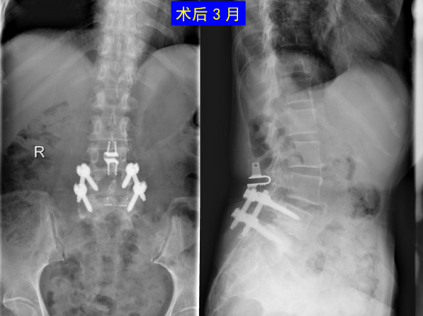 怎样判定腰椎管狭窄症的手术责任椎？