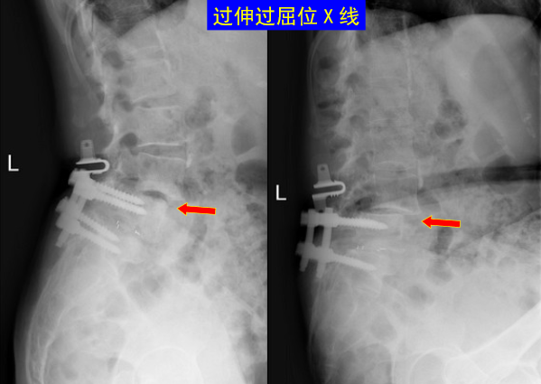 怎样判定腰椎管狭窄症的手术责任椎？