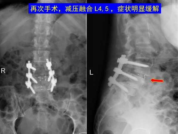 怎样判定腰椎管狭窄症的手术责任椎？