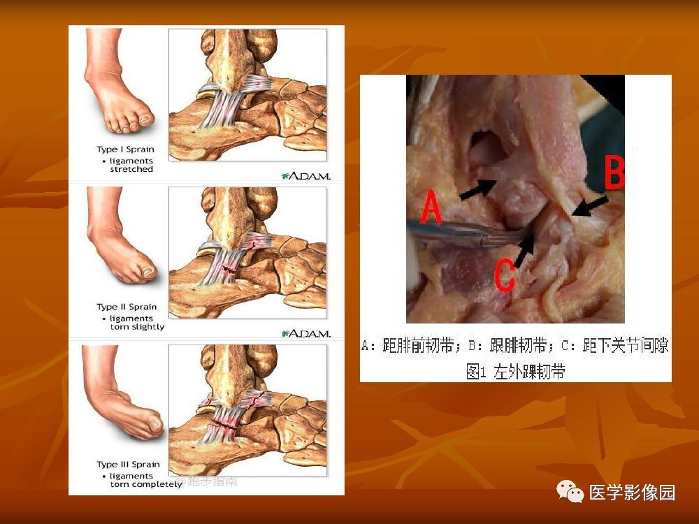 踝关节韧带的解剖及影像表现