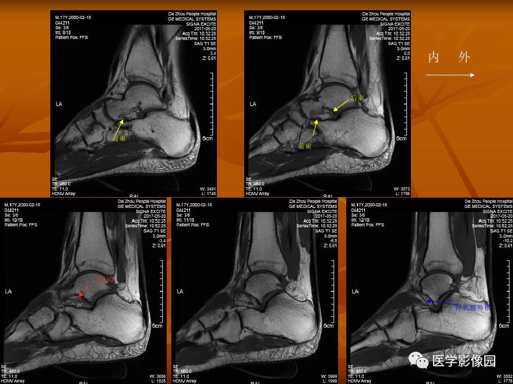 踝关节韧带的解剖及影像表现