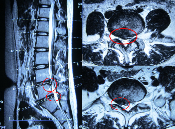 腰椎间盘突出症的病理特点和治疗策略