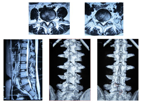 腰椎间盘突出症的病理特点和治疗策略