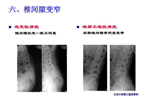腰椎滑脱的临床分型与影像学评估