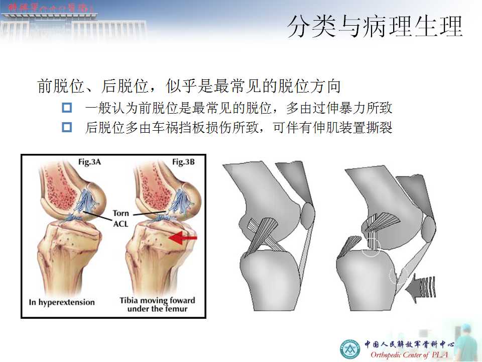 膝关节多韧带损伤的治疗要点